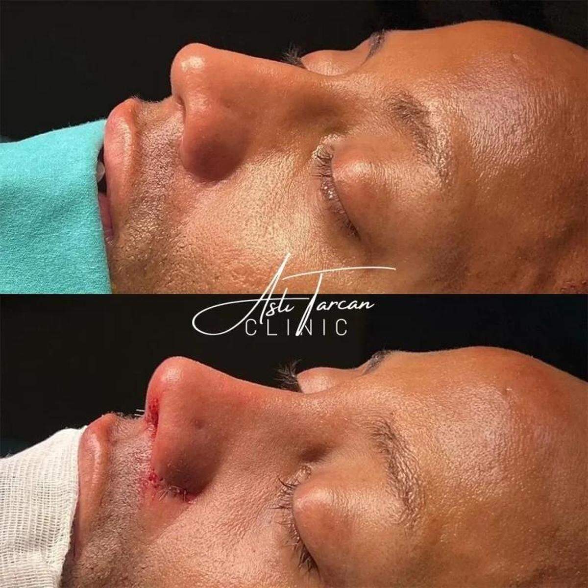Turkey Rhinoplasty