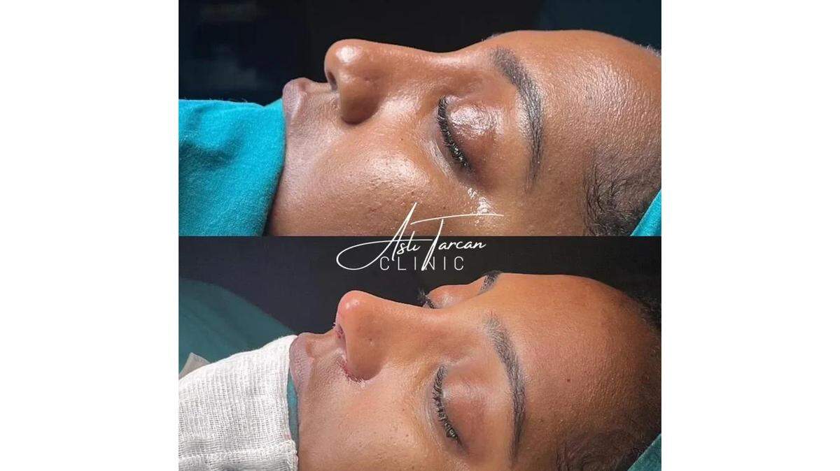 Turkey Rhinoplasty