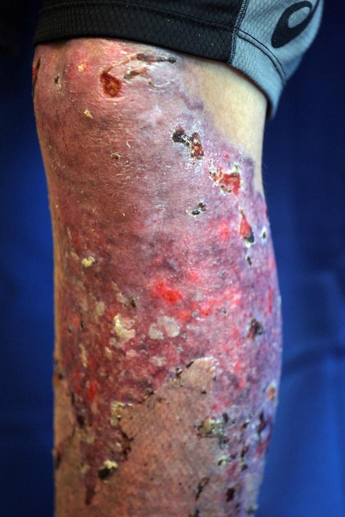 Chef Ralph Pagano, well known chef who developed the Naked Taco restaurant on the beach, shows the scars on his leg after being treated for third-degree burns at Ryder Trauma Center prior to being released on Thursday, August 10, 2017.