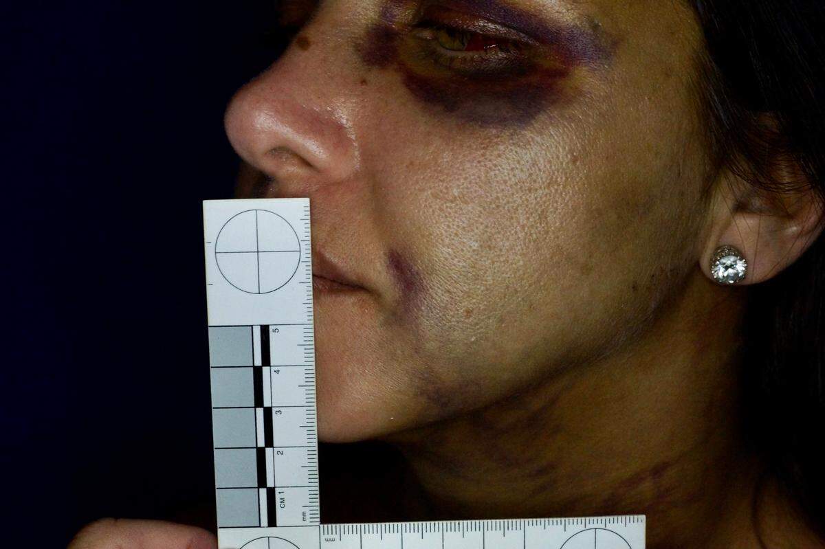 A photo of Rafael Azulay’s then-girlfriend in 2018 after the domestic violence for which he received one year of probation.