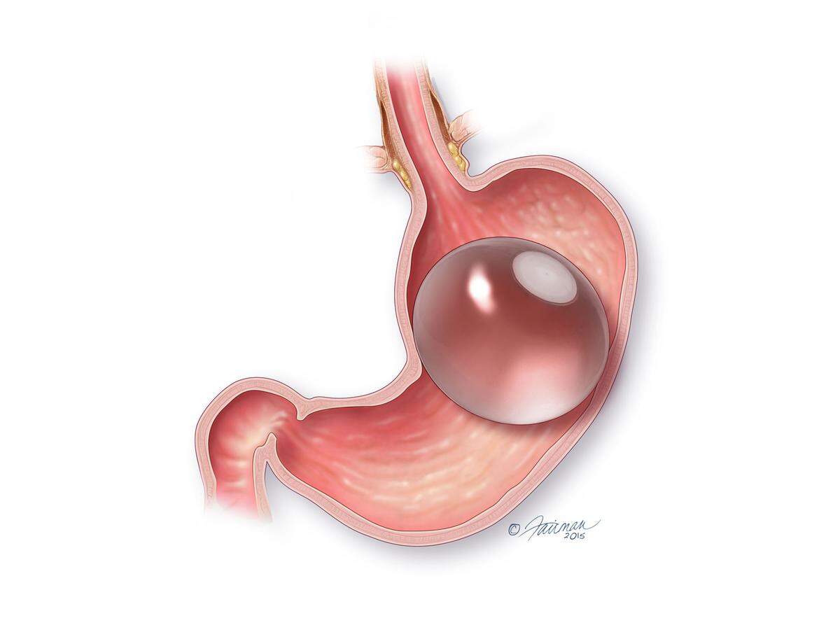 A temporary gastric balloon is placed into the stomach in the latest non-surgical endoscopic procedure designed for weight loss. The balloon is filled with saline solution and is removed after six months.