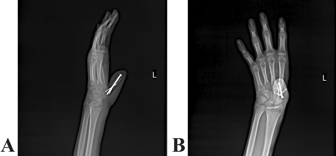The thumb was reconstructed using the preserved bone and tissue from the man’s thigh, doctors said.