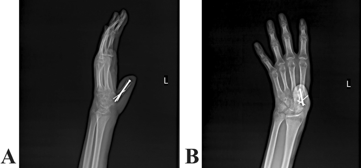 The thumb was reconstructed using the preserved bone and tissue from the man’s thigh, doctors said.