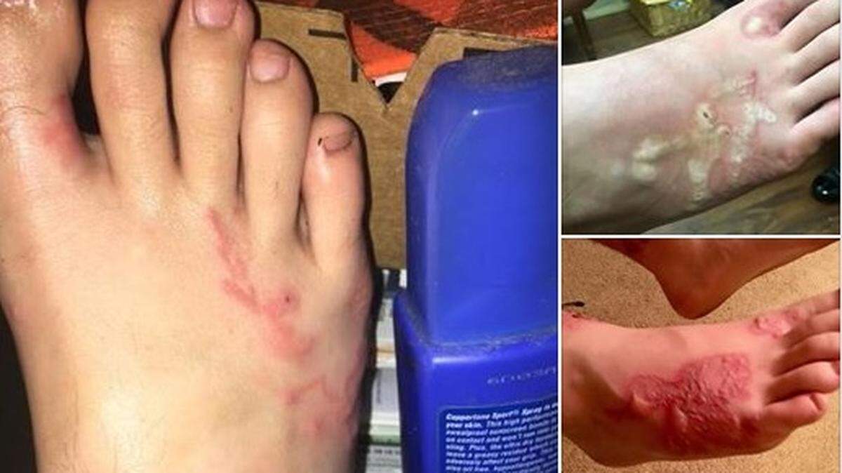 A Tennessee contracted hookworm from the sand of a beach in Pompano Beach, his mother said in a Facebook post.