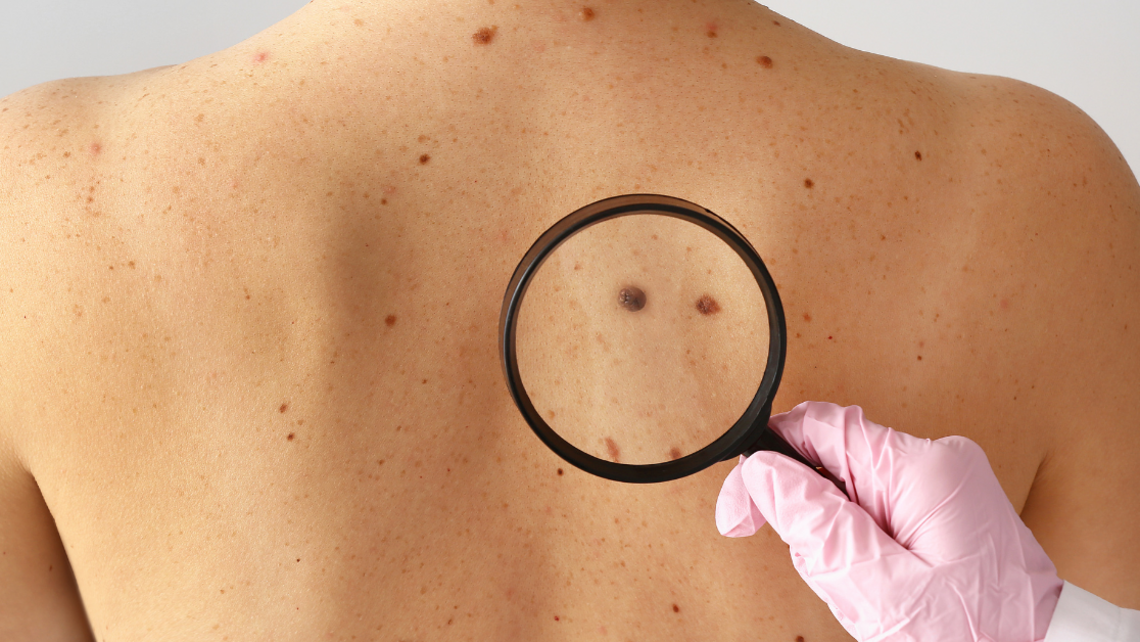Here’s what to expect at your skin cancer screening exam