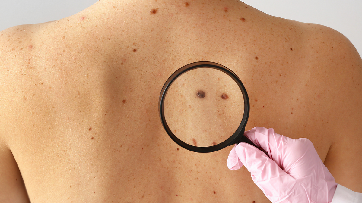 Got a suspicious-looking mole? Best to have it looked at.