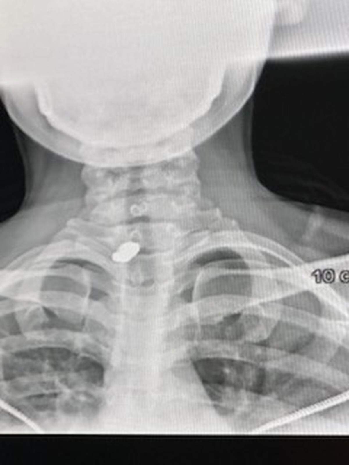 An X-ray image shows a bullet lodged in the neck of Esha Dawkins, who was shot while driving on Interstate 95 on Monday, Nov. 25, 2024.