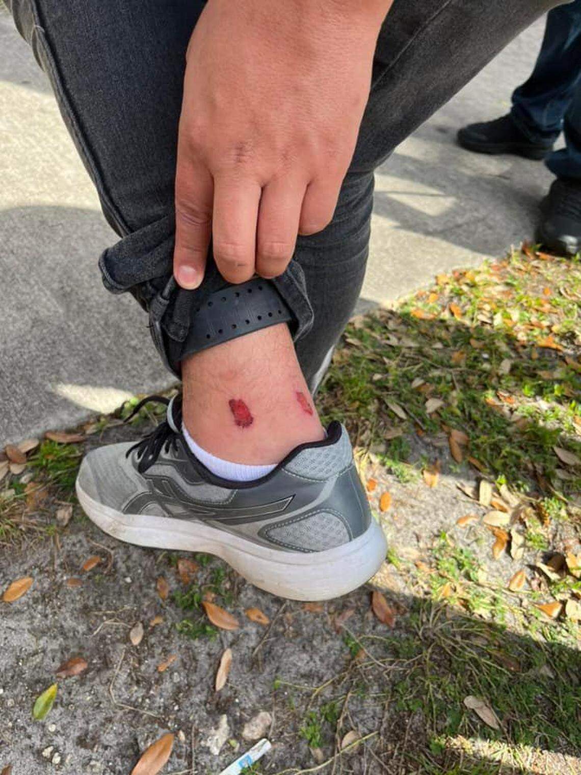 An immigrant man lifts his jeans outside the Miramar ICE office to show open sores that are allegedly from wearing an ankle monitor. 