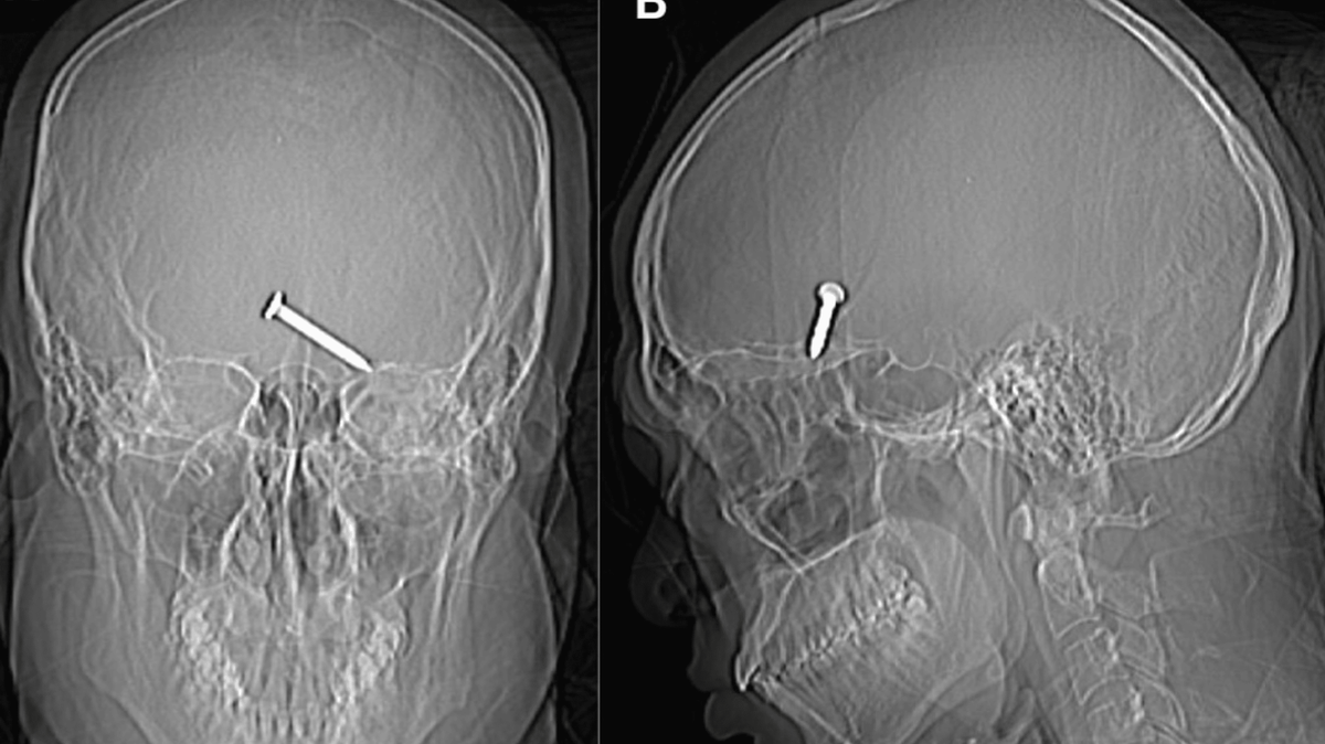 A construction worker in Malaysia was using a malfunctioning nail gun when it shot a nail into his left eye, according to a medical case report.