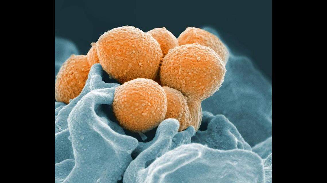 This handout image provided by the National Institute of Allergy and Infectious Diseases shows an electron microscope image of Group A Streptococcus (orange) during phagocytic interaction with a human neutrophil (blue). The same bacteria that cause simple strep throat sometimes trigger bloodstream or even flesh-eating infections instead, and over the years, dangerous cases have increased. Now researchers have uncovered how some strains of this bug evolved to become more aggressive.