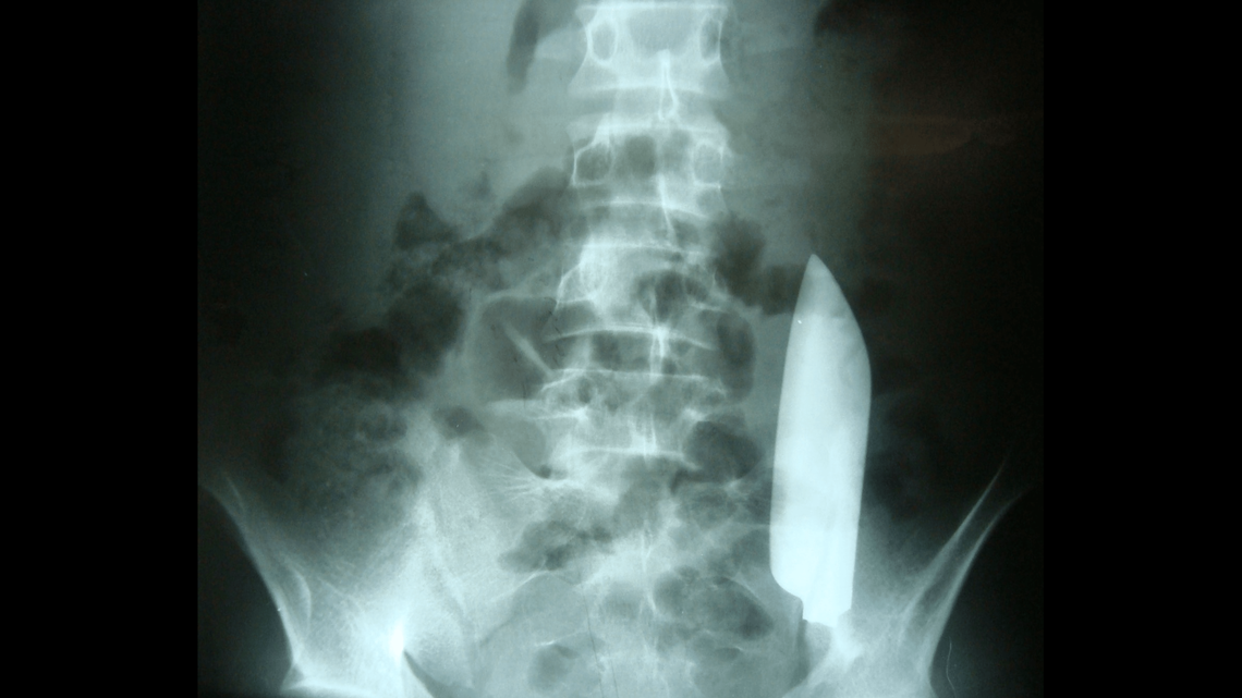 A day after a man was stabbed in Nepal, doctors found the blade of the knife still lodged in his body.