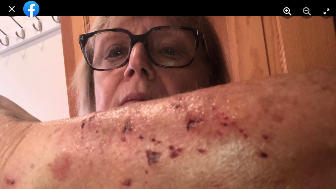 Donna Sanginario, of Lancaster, Massachusetts, said she was hanging Christmas lights when she was attacked by a raccoon and had to get rabies shots afterward.
