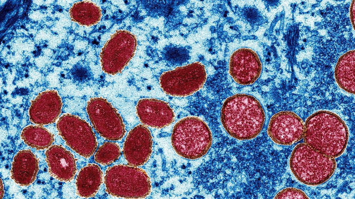 An electron microscope image show monkeypox virus particles from a human skin sample from the 2003 outbreak.