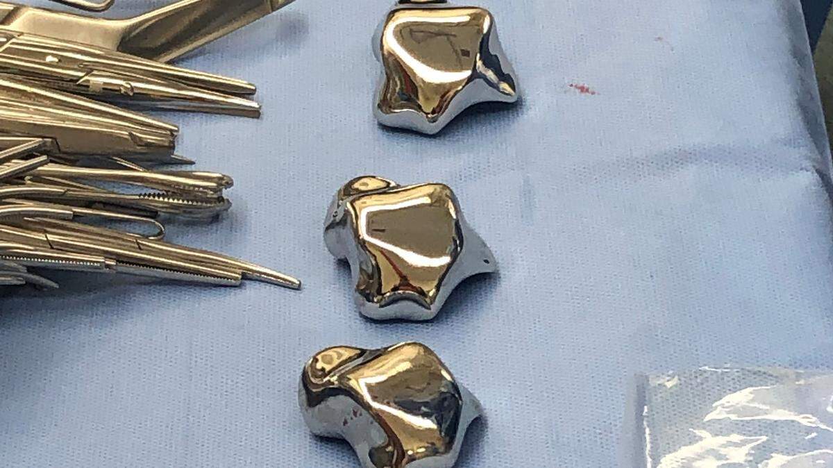 Surgeons at the University of Miami ordered three versions of a 3D-printed ankle bone implant made out of cobalt chrome by Restor3D, a company in Durham, North Carolina. The implants came in three sizes in case the estimated fit was off. The surgeons successfully implanted the true-size fit during a novel surgery.