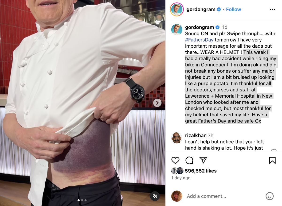 Chef Gordon Ramsay is revealing the horrific injury he suffered after getting into a bad bike accident.