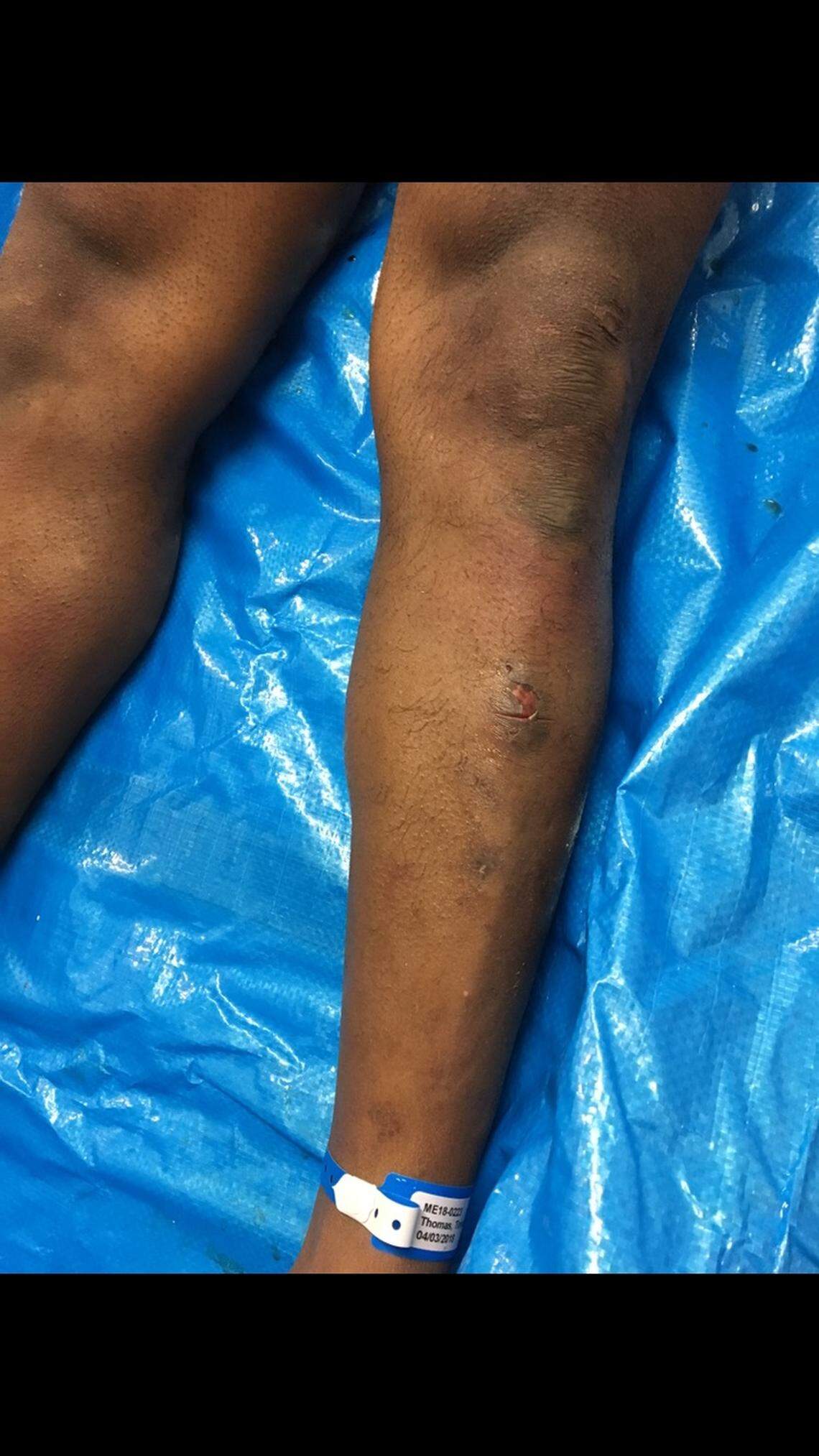 Bruises and lacerations can be seen covering Timothy Thomas' body in postmortem photos provided by the family.