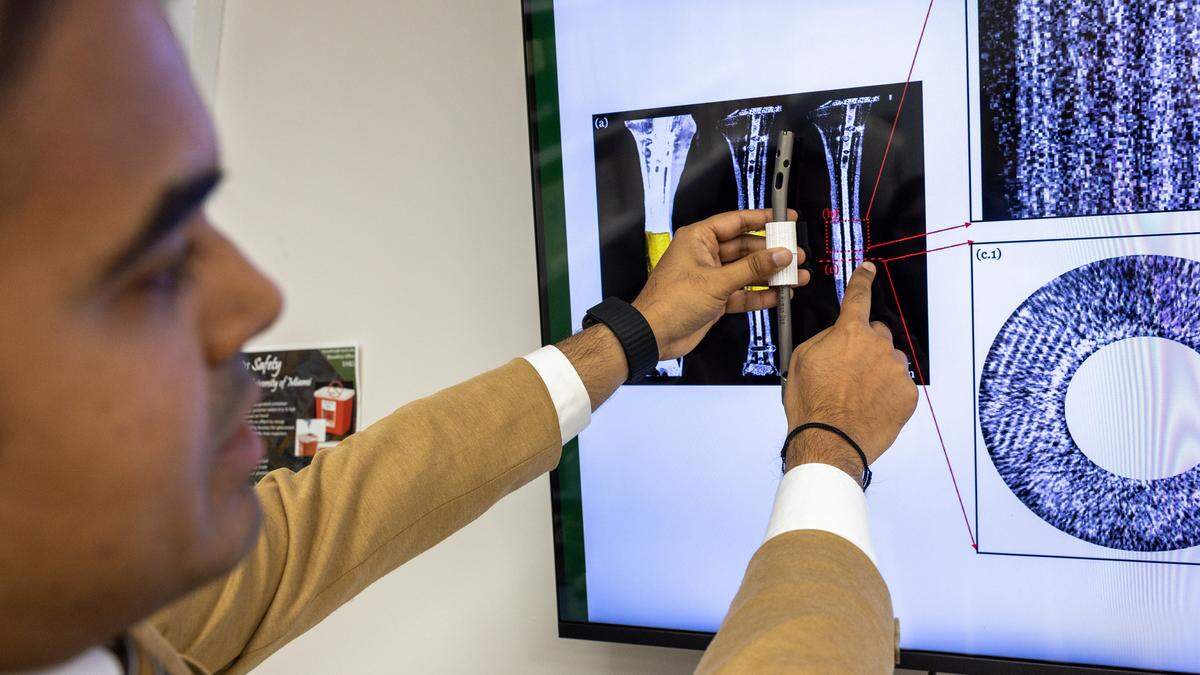 Vasudev Vivekanand Nayak, the 3D-bioprinting facility’s operational manager, holds 3D-printed bone regeneration components — an intramedullary nail and a bioactive, resorbable ceramic scaffold — next to their digital rendering at the 3D Bioprinting Facility at the University of Miami Miller School of Medicine in Miami on Tuesday, June 2, 2026.