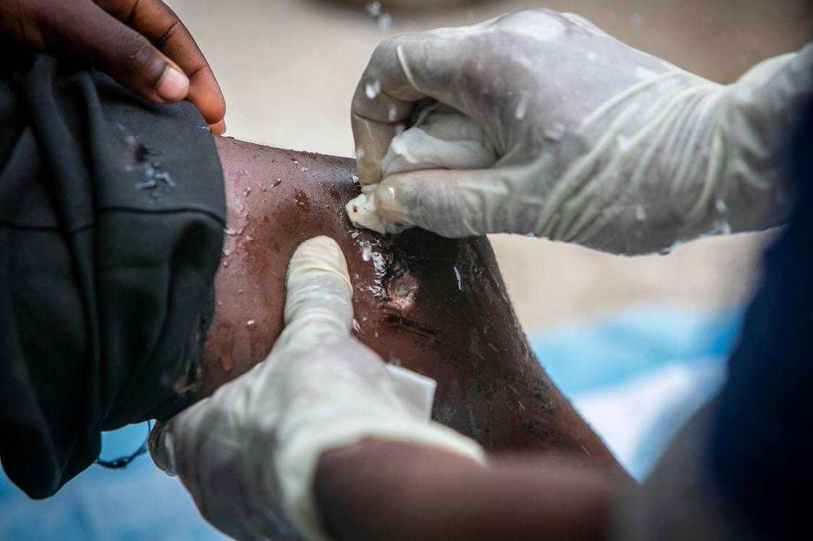 Marceline, Haiti, August 18, 2021 - Dr. Timothee Jean-Jacques takes care of a childs wound at the tent they set up in an empty field near a collapsed school in Marceline. Doctors Timothee Jean-Jacques, Wonston Raphael, Ruben Misaac Pierre, Stanley Ettenne, Medgina Felix and Physical Therapist Rose-Milord Celestin, used their own money to buy medicals supplies and transported themselves and the supplies to Marceline to help out the victims of the earthquake.