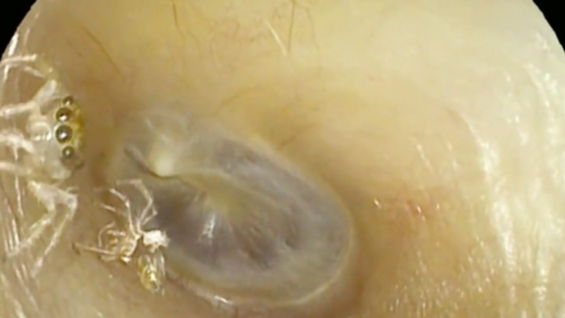 The woman heard weird noises in her ear for four days before the spider was discovered, according to the case report.