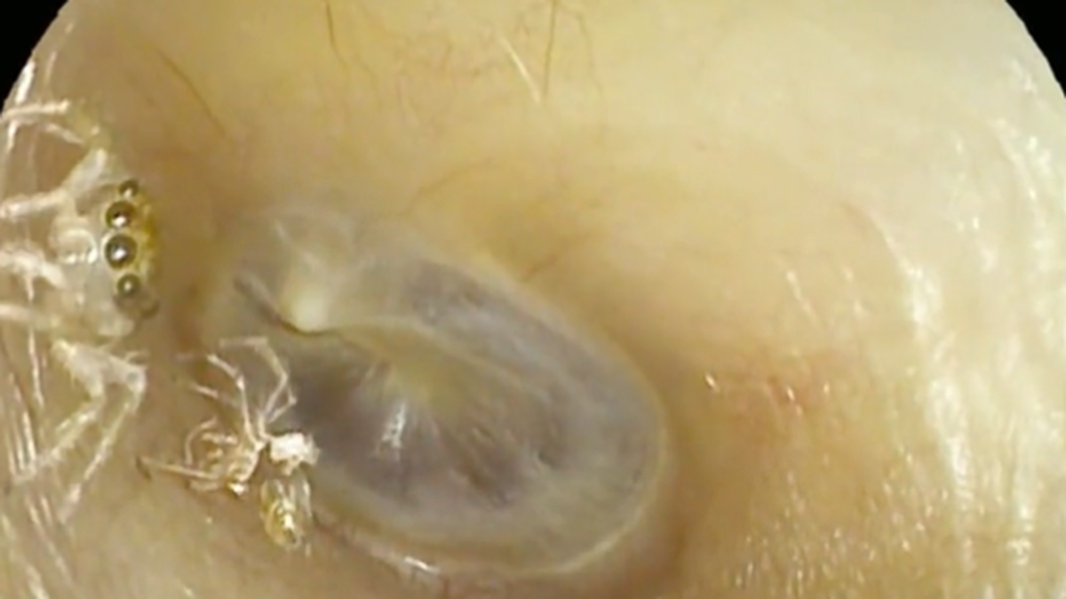 The woman heard weird noises in her ear for four days before the spider was discovered, according to the case report.