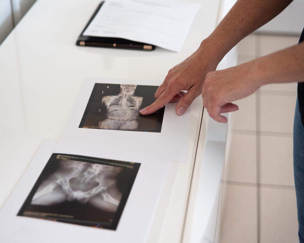 Yordanka Fernandez shares scans showing her son’s scoliosis, taken on Nov. 13.