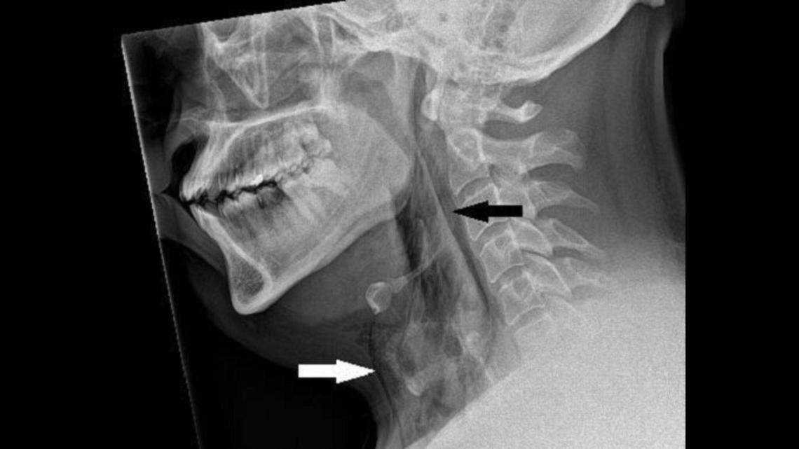 The stifled sneeze tore through the lining of the man’s trachea, doctor’s said, as seen on X-ray marked by the black arrow.