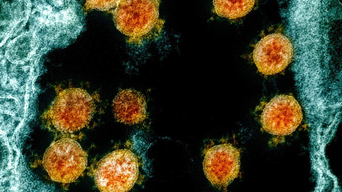 This electron microscope image made available and color-enhanced by the National Institute of Allergy and Infectious Diseases Integrated Research Facility in Fort Detrick, Md., shows Novel Coronavirus SARS-CoV-2 virus particles, orange, isolated from a patient.