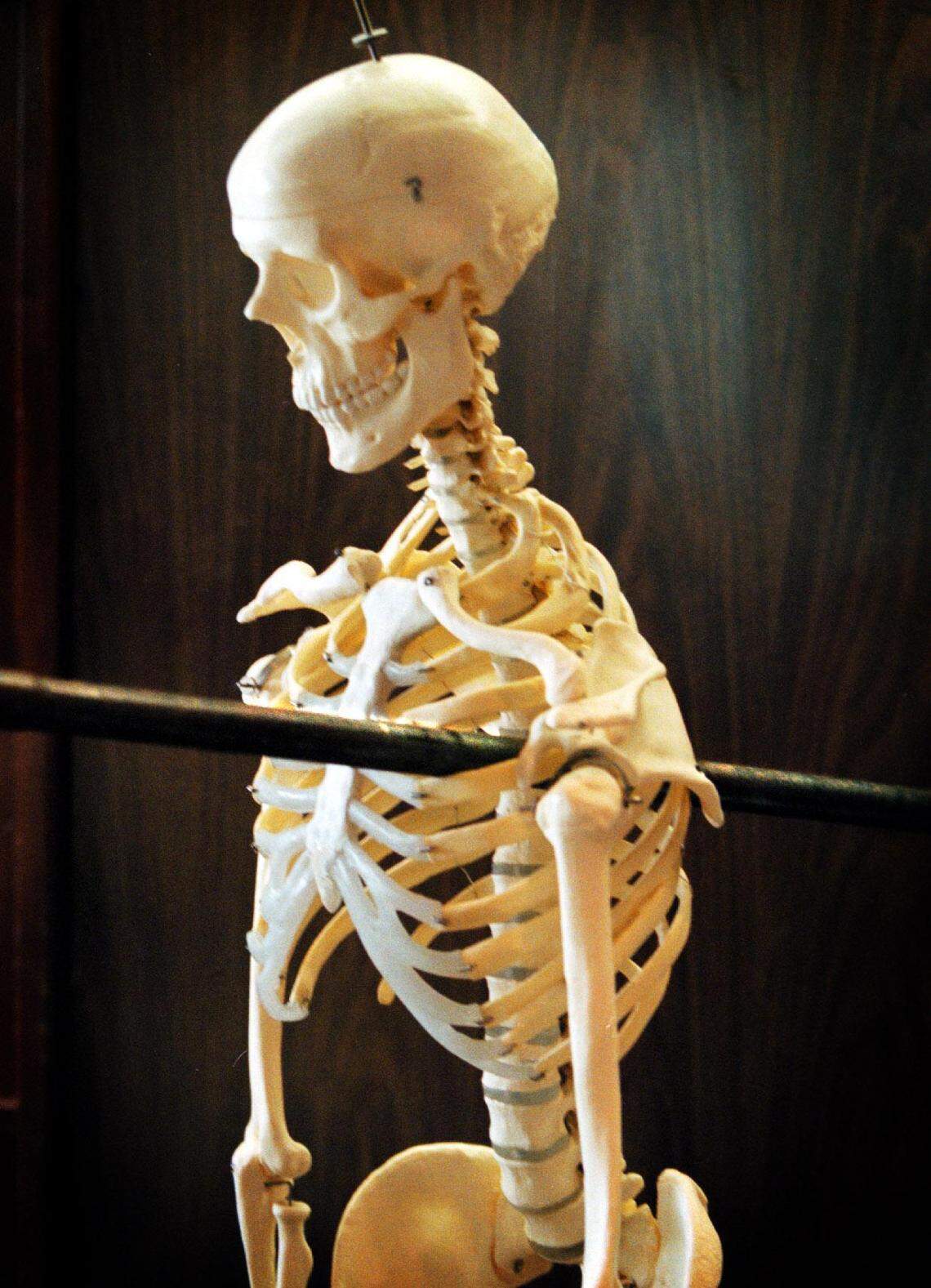 BROWARD 6/4/98--Press conference for Stephanie Murray, the girl that was impaled by a steel rod last night was held at Broward General Medical Center this morning. Pictured is a skeleton with a similar rod passing through the ribs just as was the case with Stephanie.