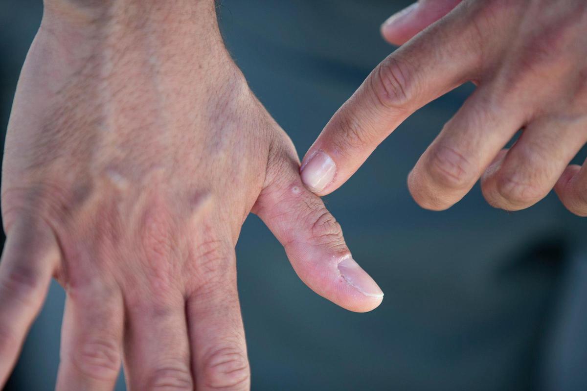 Hollywood resident Victor Infante, 35, shows a blister or pimple on his hand caused by the monkeypox virus on Wednesday, July 20, 2022.