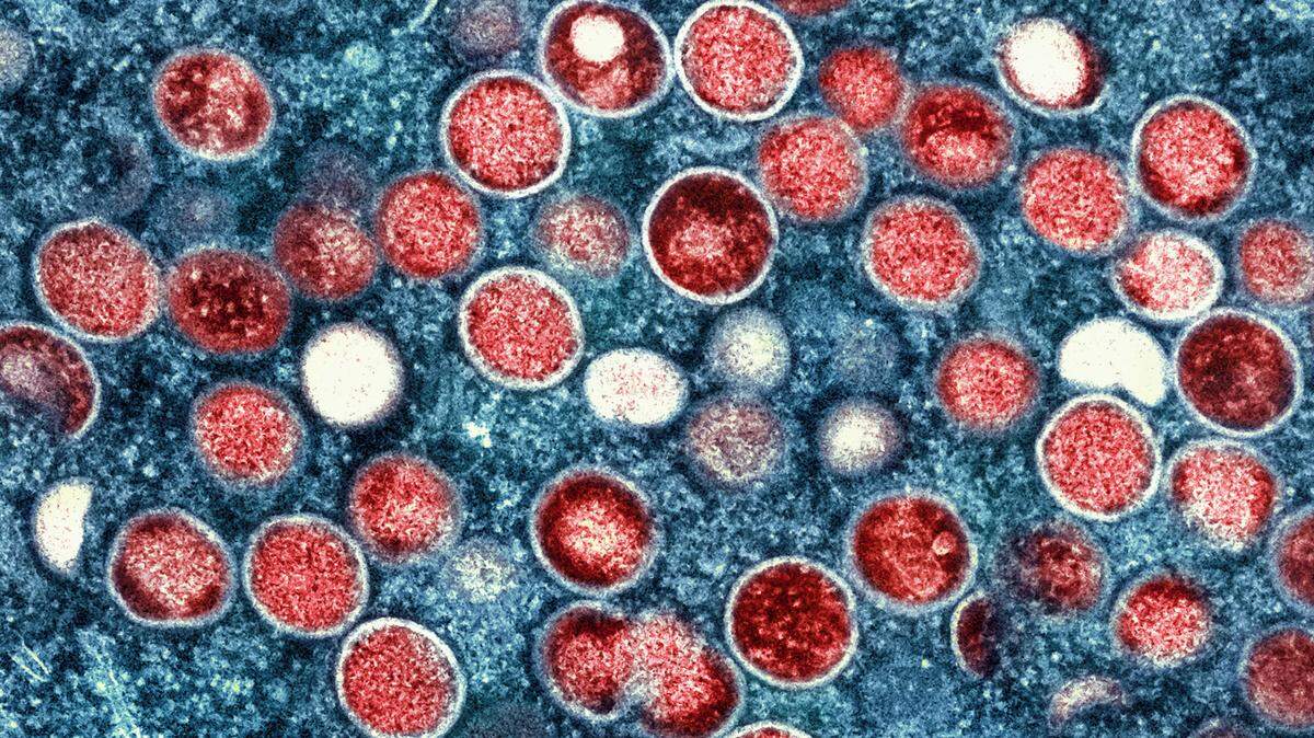 This image provided by the National Institute of Allergy and Infectious Diseases (NIAID) shows a colorized transmission electron micrograph of monkeypox particles (red) found within an infected cell (blue), cultured in the laboratory that was captured and color-enhanced at the NIAID Integrated Research Facility (IRF) in Fort Detrick, Md.