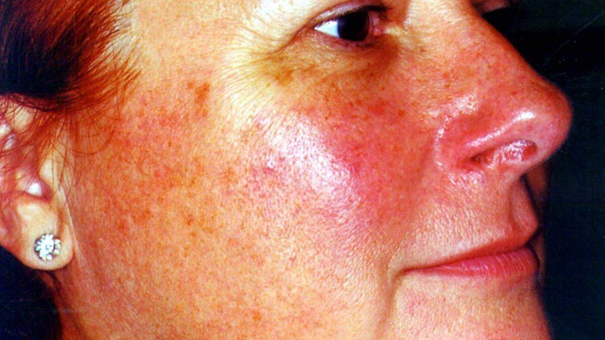 Rosacea, a skin condition known for facial redness, may be caused by a microsopic mite found on the skin.