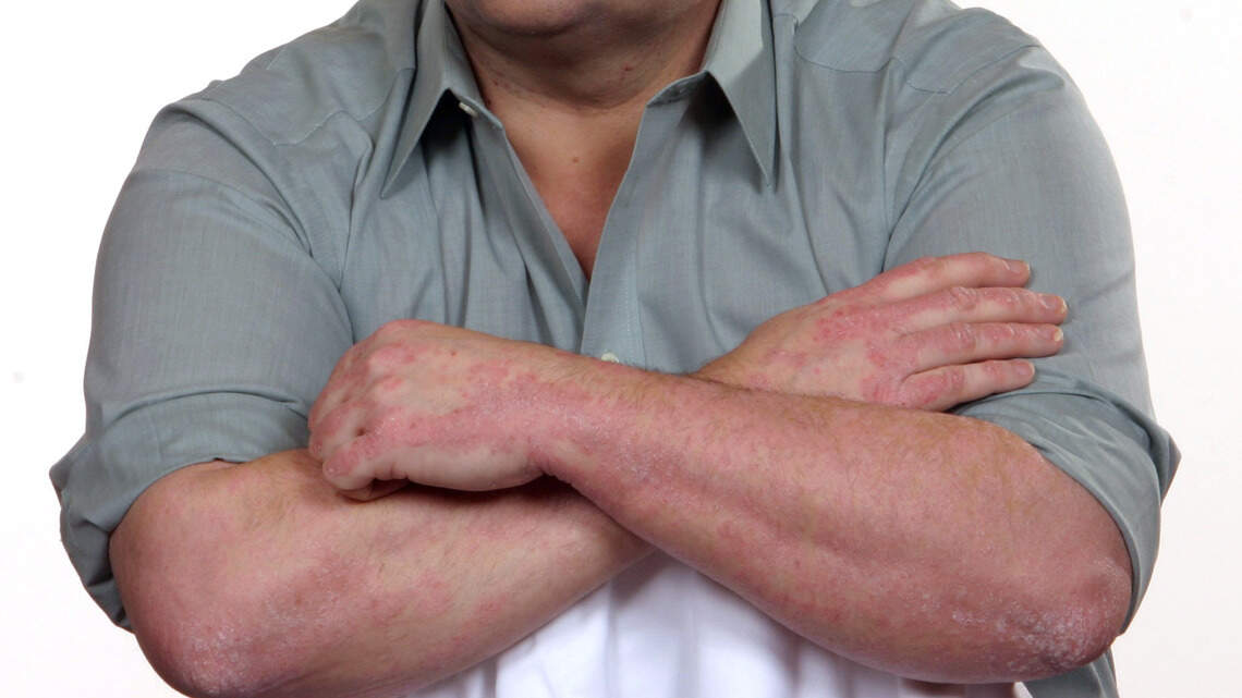 A new treatment may be available for this skin condition — and it’s a pill