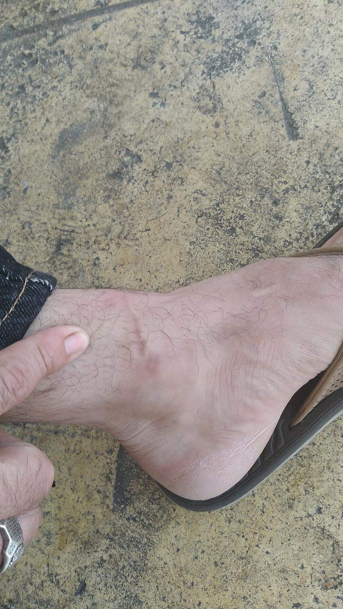 Yuri Chavarria Rugama, an immigrant from Nicaragua, shows the marks wearing an ankle monitor has caused on his leg. 