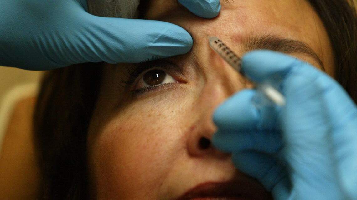 Is bruising normal after getting hyaluronic acid (HA) fillers?