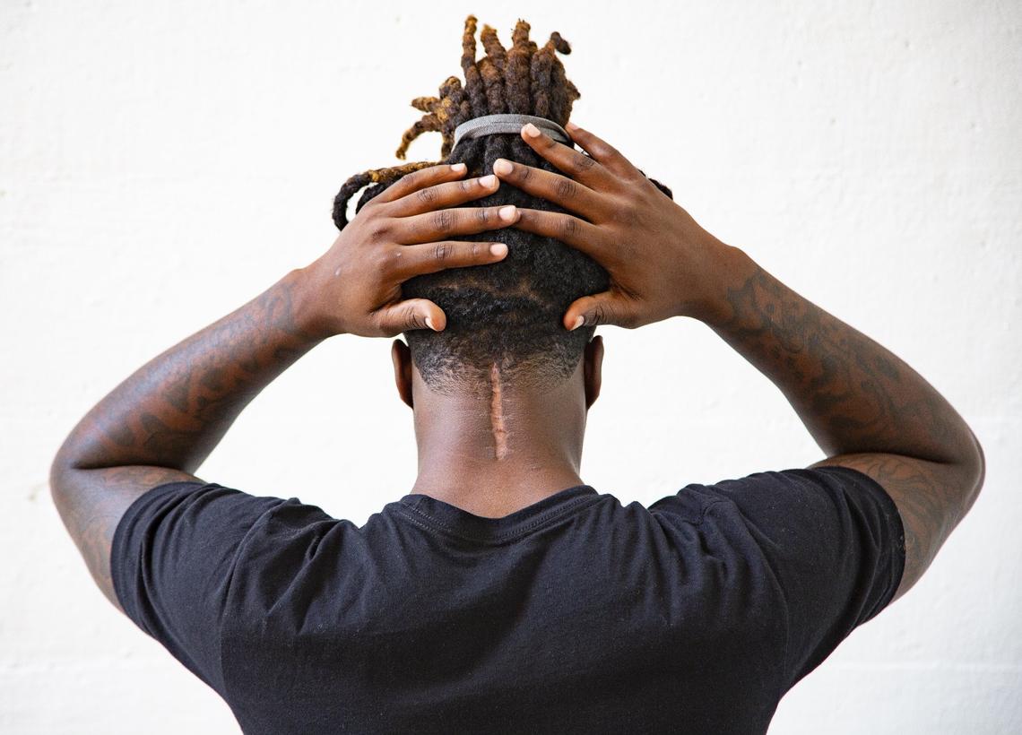 Former University of Miami football cornerback Malek Young on Friday, June 1, 2018 as he shows the scar from surgery on the back of his neck. Young's final game of his sophomore season turned out to be the final game of his career. A helmet-to-helmet clash with a Wisconsin player during a kickoff return in the Capital One Orange Bowl resulted in a severe neck injury that required surgery and ended Young's career. Always a good student, he's still on scholarship. He also is an entrepreneur, having started a clothing business called "Humble Child,'' his Twitter profile name.