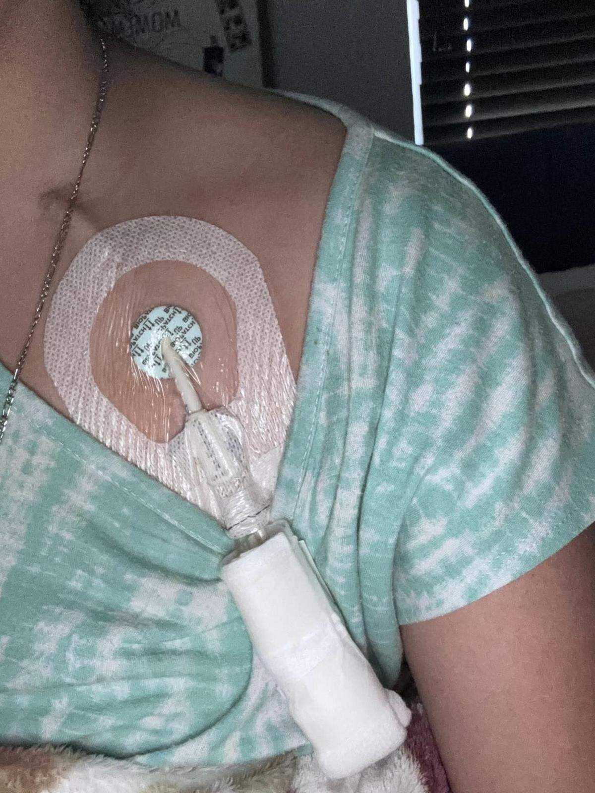 A catheter was placed in Brittany Calispa's chest to give her treatment for her kidneys. 