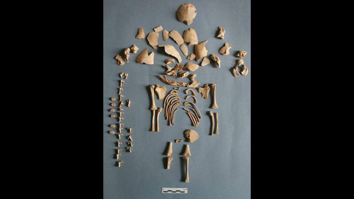 Researchers analyzed the remains of infants buried across Europe and found six cases of Down syndrome and one case of Edwards syndrome, according to the study.