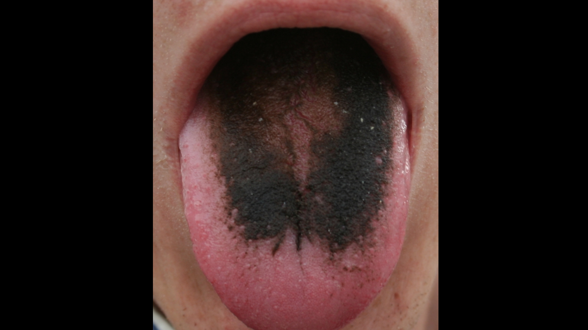 A subject with black hairy tongue syndrome.