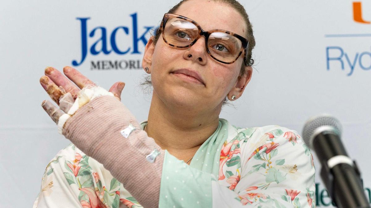 Burn survivor Cassandra Rivera displays the injuries to her left arm as she speaks to the media about the boat explosion off Fort Lauderdale on Memorial Day during a press conference Wednesday at Ryder Trauma Center.