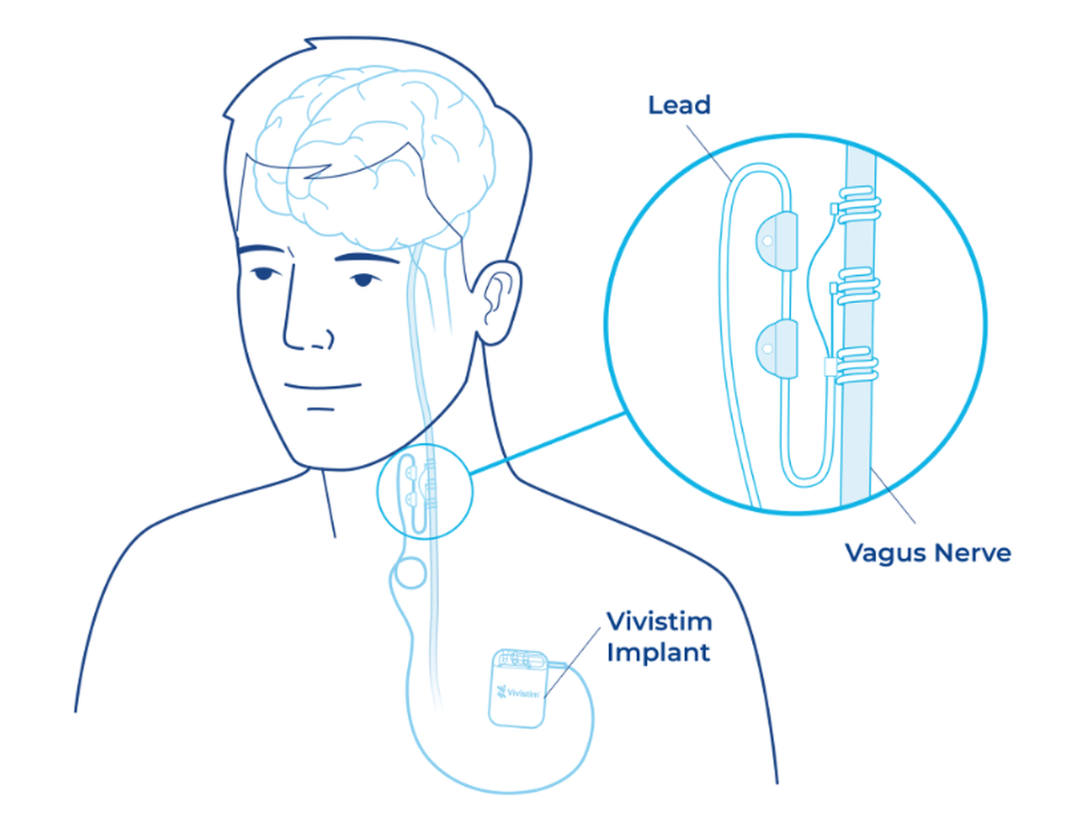 The Vivistim Paired VNS System is a small pacemaker-like device that is implanted in the upper left chest and neck area.