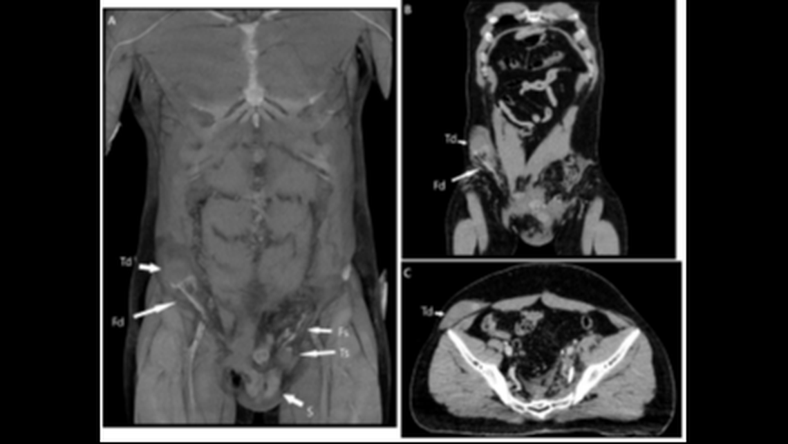 The man’s testicle, marked by the letters “Td,” moved to the upper right portion of his pelvis, doctors said.