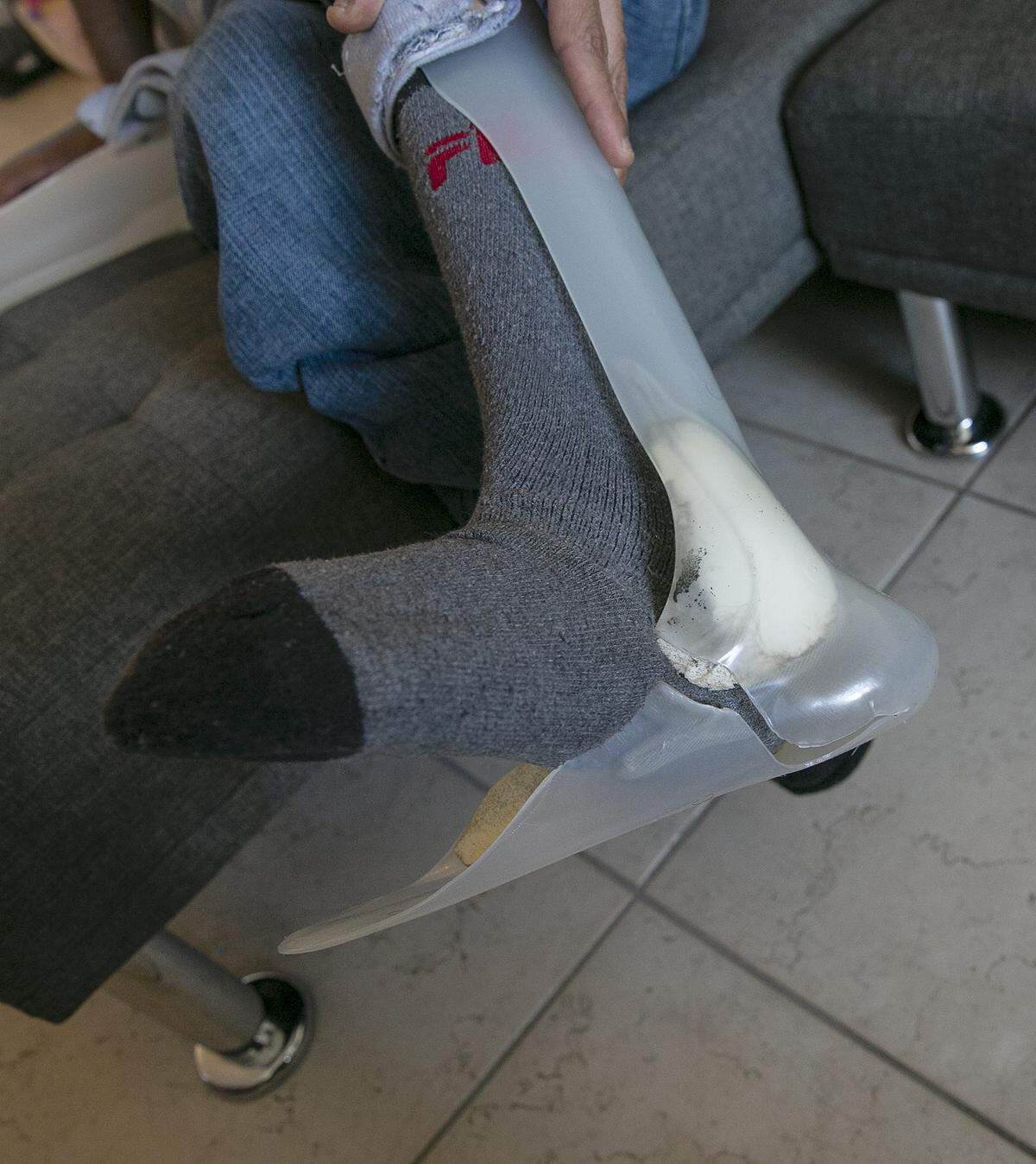 Detalle del “leg brace” roto que Rolando Ramírez necesita reemplazar para poder caminar.