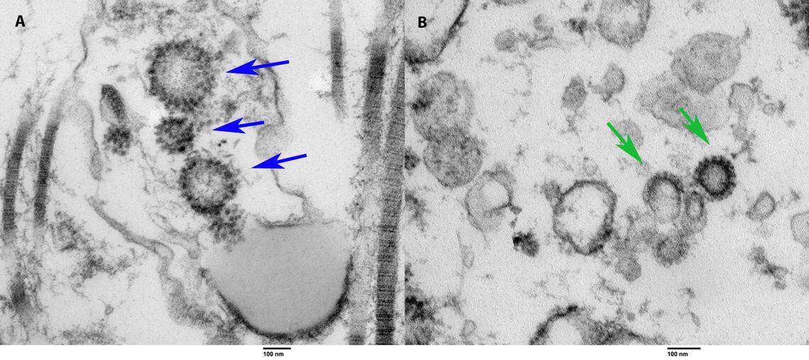 COVID-19 viral particles found via electron microscopy. On the left is tissue taken from a live, previously COVID-positive patient. On the right is tissue collected via autopsy from a person who died of COVID-19. The arrows point toward the spiked COVID viral particles in both specimens, according to a study by University of Miami doctors.