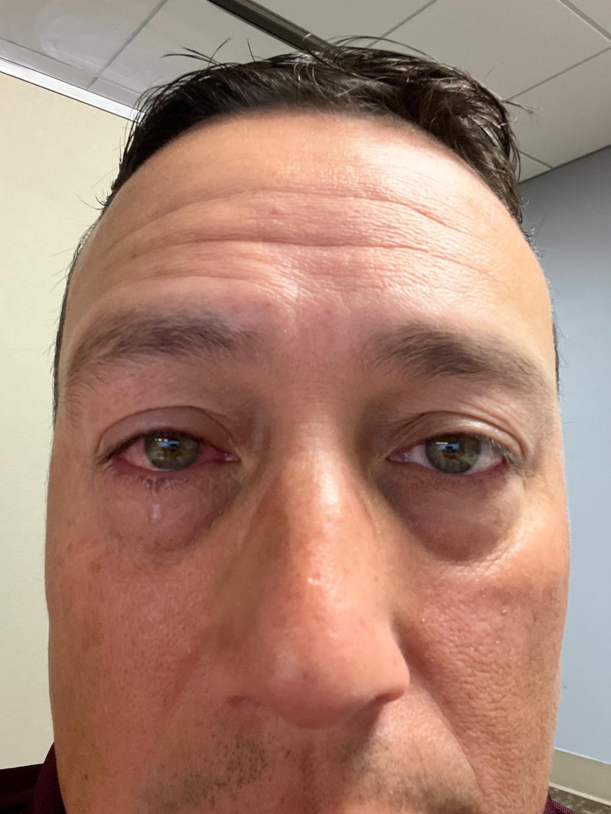 Soren Morales, a 52-year-old native of Nicaragua who lives in Miami, is pictured here the day after he was struck in his right eye by a pickleball that flew errantly off the paddle of his doubles partner on January 22, 2024.