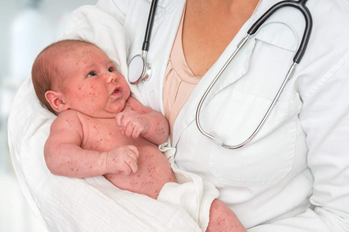 California continues to see a rise in measles cases in 2026, according to public health officials.