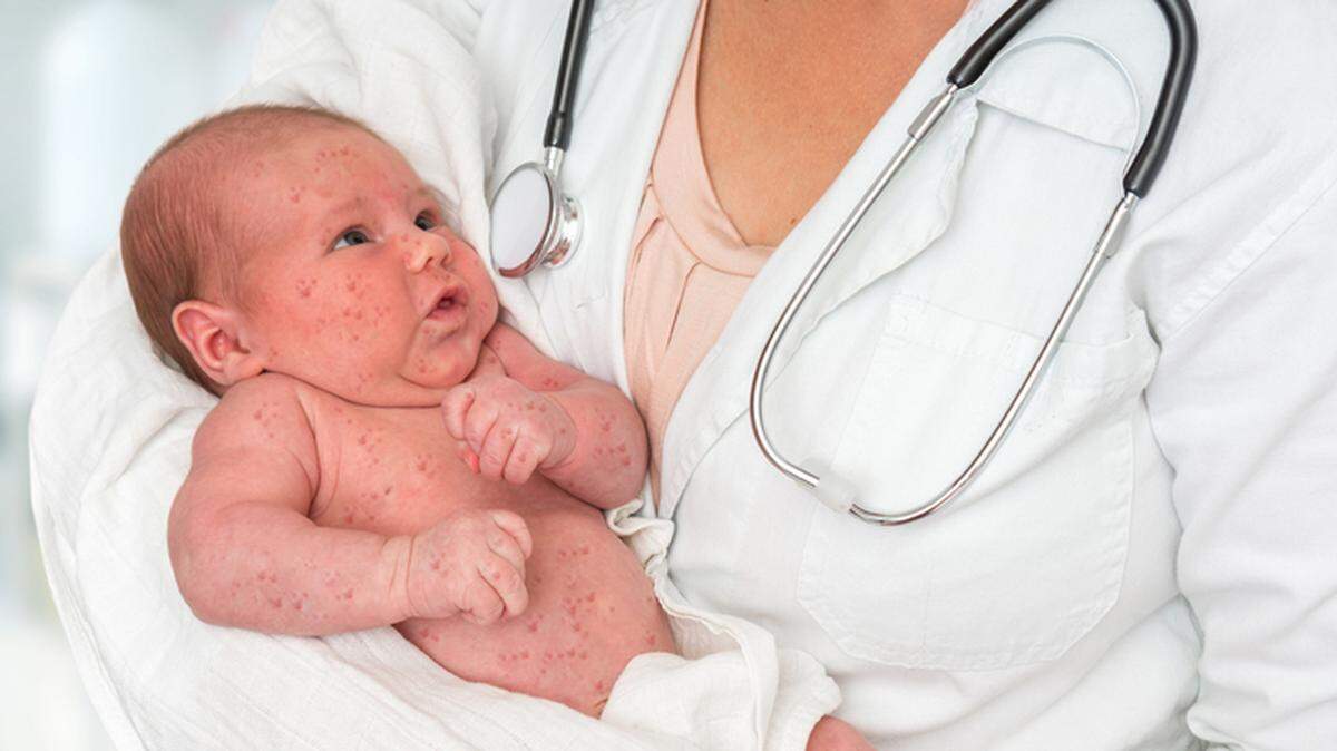 Several states are experiencing an outbreak of measles, a disease thought to have been eradicated.