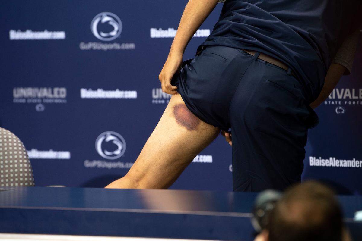 Penn State head coach James Franklin reveals a bruise from a recent players versus coaches paintball game, at an NCAA college football media day at Beaver Stadium on Saturday, Aug. 4, 2018, in State College, Pa.