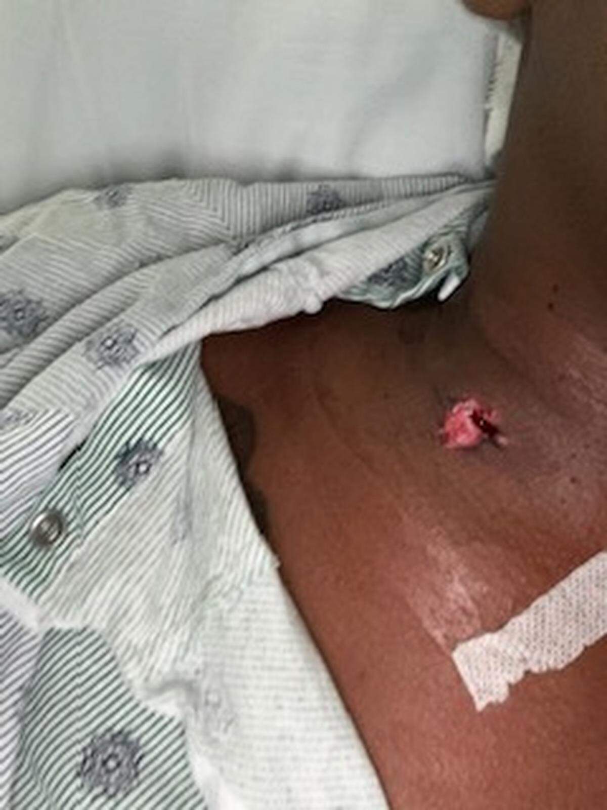 A photo shows the wound in Esha Dawkins’ neck after she was shot while driving on Interstate 95 on Monday, Nov. 25, 2024.