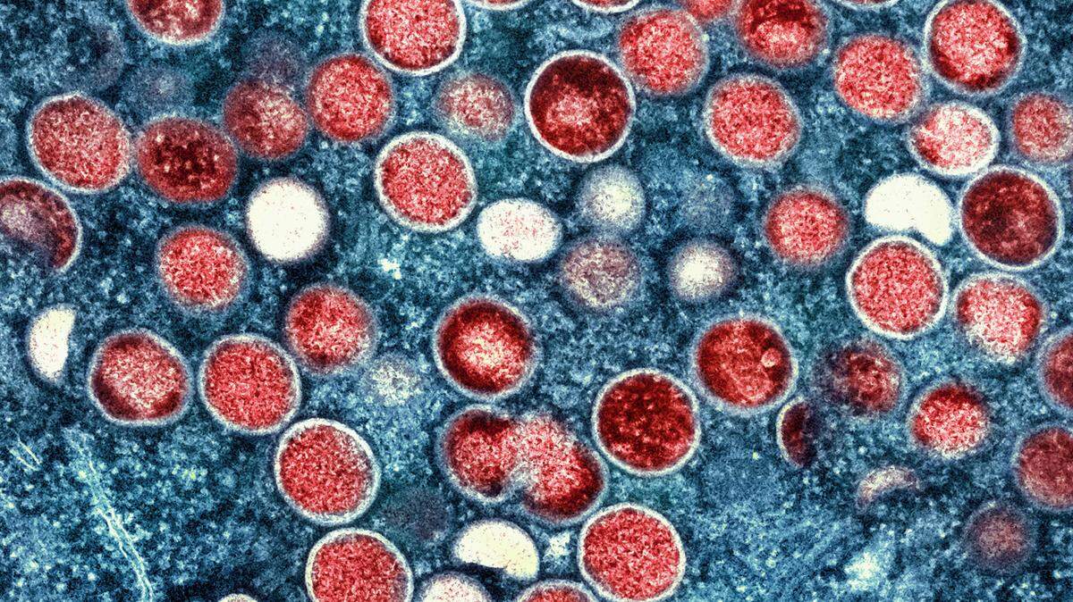 Unlike COVID-19, which is spread by contact with droplets and particles from a person infected with the virus, monkeypox requires physical, skin-to-skin or skin-to-rash contact.