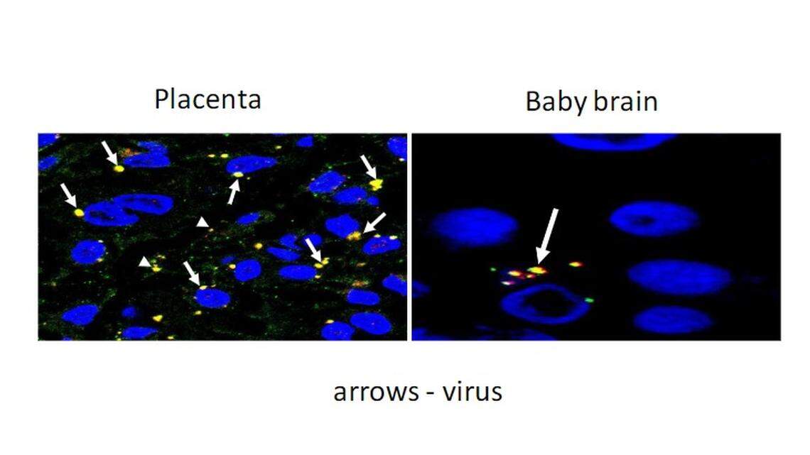 Researchers at the University of Miami Health System and the University of Miami Miller School of Medicine have shown that, in two cases, COVID-19 infection breached the placenta and caused brain damage in the newborn.